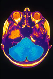 Cerebral Cortex Structure Drucke: MRI of Brain