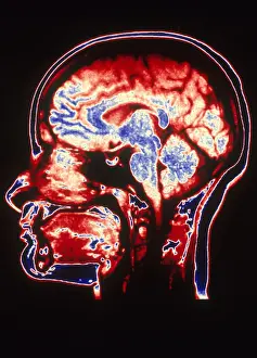 Normal Brain Anatomy Drucke: MRI of Head