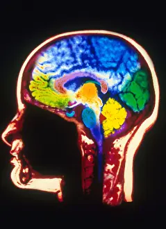Magnetic Resonance Imaging (MRI) Drucke: MRI of Head