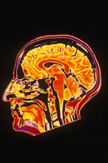 Normal Brain Anatomy Drucke: MRI of Head