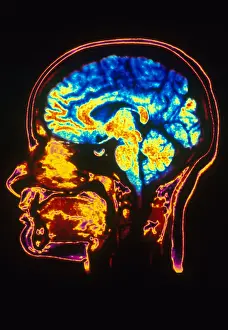 Normal Brain Structure Drucke: MRI of Head