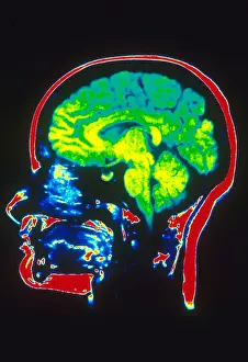 Normal Brain Structure Drucke: MRI of Head