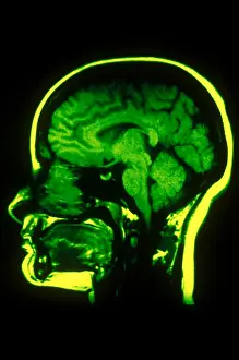 Normal Brain Structure Drucke: MRI of Head