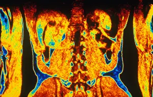 Spinal Cord Anatomy Drucke: MRI of Human Torso