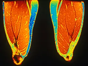 Magnetic Resonance Imaging Drucke: MRI of Upper Thighs