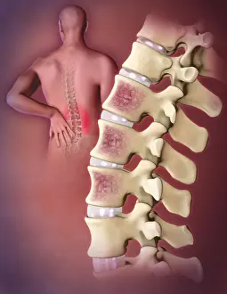 Osteoporosis Symptoms Drucke: Multiple Myeloma