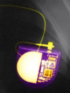 Medical Imaging Technology Drucke: Pacemaker