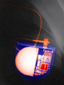 Medical Imaging Technology Drucke: Pacemaker