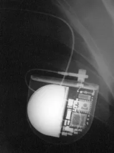 Medical Imaging Technology Drucke: Pacemaker