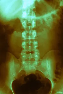 Medical X Ray Images Drucke: Normal Abdomen and Colon