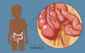 Human Digestive System Illustration Drucke: Normal Appendix