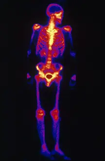 Medical Imaging Techniques Drucke: Normal Bone Scan