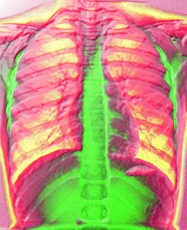Medical Computer Graphics Drucke: A normal chest X-ray