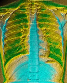 Medical Computer Graphics Drucke: A normal chest X-ray