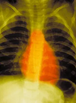 Human Respiratory System Anatomy Drucke: Normal chest x-ray