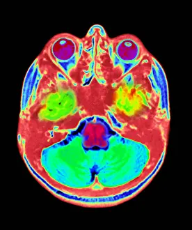 Normal Brain Anatomy Drucke: Normal MRI