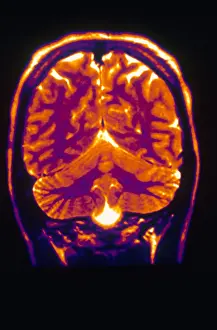 Normal Brain Anatomy Drucke: Normal MRI of Brain