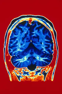 Magnetic Resonance Imaging (MRI) Drucke: Normal MRI of Brain