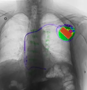 Human Anatomy Drucke: Pacemaker