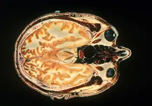 Human Brain Anatomy Drucke: Slice of Human Brain, gross specimen