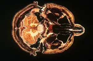 Human Brain Anatomy Drucke: Slice of Human Brain, gross specimen