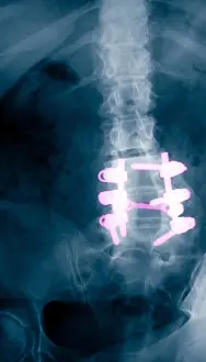 Vertebral Column Anatomy Drucke: Spinal Fusion
