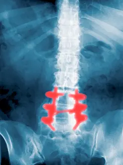Human Vertebral Column Drucke: Spinal Fusion