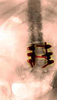 Medical X Ray Images Drucke: Spinal Fusion