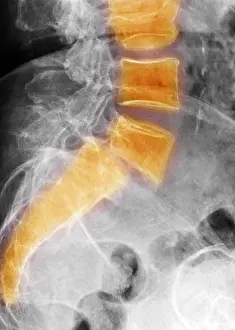 Human Spine Anatomy Drucke: Spondylolisthesis