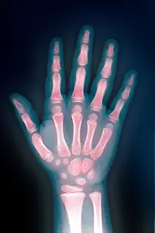 Child Development Stages Drucke: X-ray of hand
